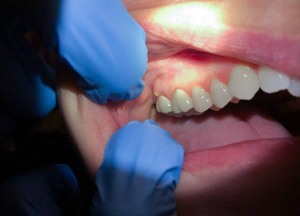 Best Emergency Tooth Extraction in Conning Towers Nautilus Park, CT